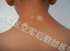 ��ͯ���综������ʳ��Ҫ����ʲô