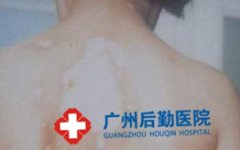 ��ֹ�ڰ�����ʲô֢״