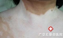 �����л��ϰ�����ʲô֢״����